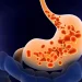 Acid Reflux and GERD