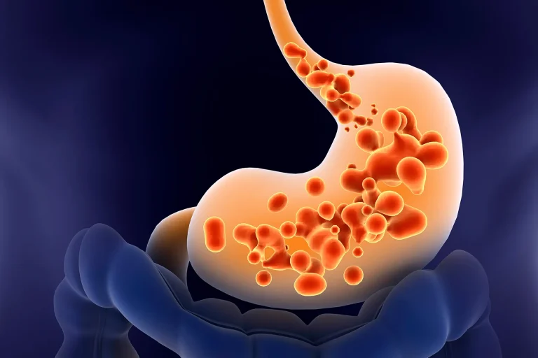 Acid Reflux and GERD