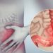 Irritable Bowel Syndrome